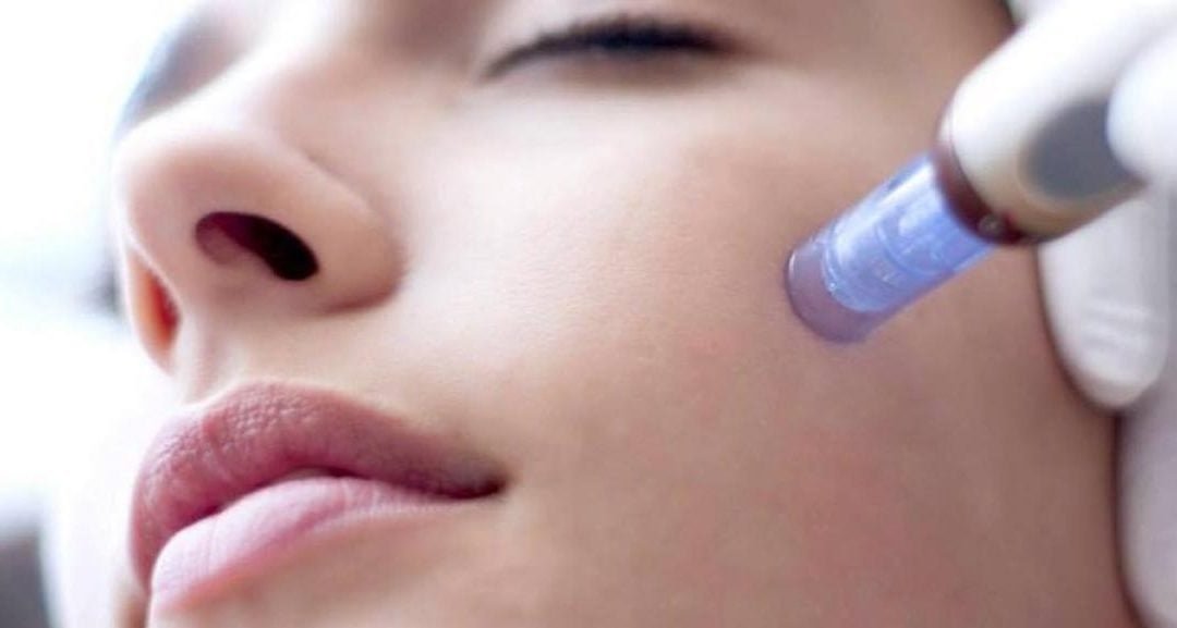 The Top 3 Ways in Which Microneedling Could Improve the Texture of Your Skin